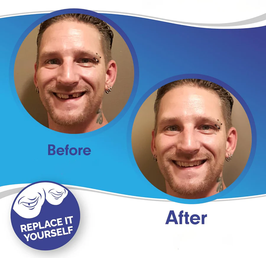 Smile Enhancer | Full Dental Veneer Kit with Adjustable Fit | Natural Look for Instant Confidence